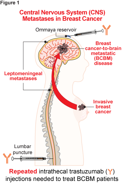 Adeno-associated virus-mediated trastuzumab delivery to the